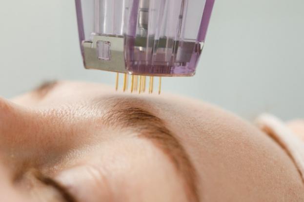 microneedling