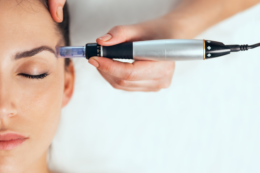 Microneedling sur la tempe gauche